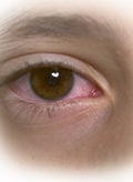 vörös szemek diabétesz kezelésére