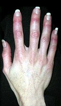 Hidegben elfehéredő ujjak: Raynaud-kór és Raynaud-szindróma
