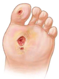 angiopathia lábak cukorbetegséggel