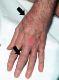 csípőízületi fájdalom 50 éves férfi esetében a kéz csontjai és ízületei fájnak
