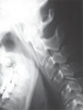 a nyaki gerinc rheumatoid arthritise)